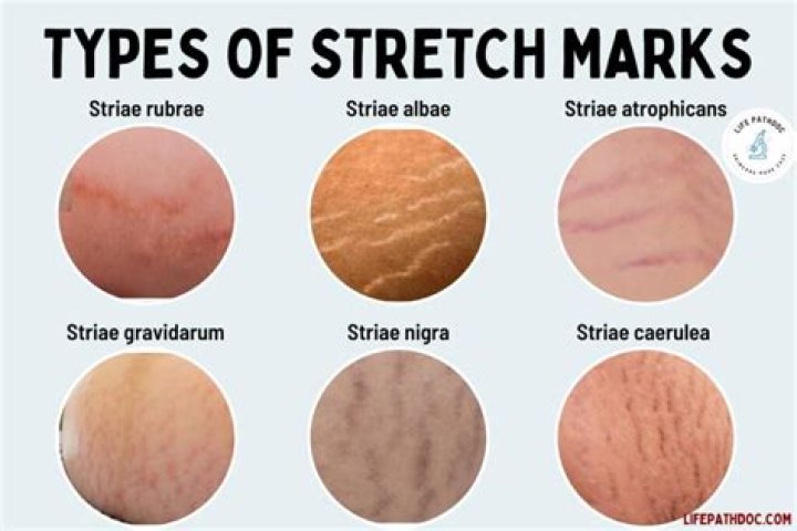 Natural and Potent Home Remedies to Battle Stretch Marks