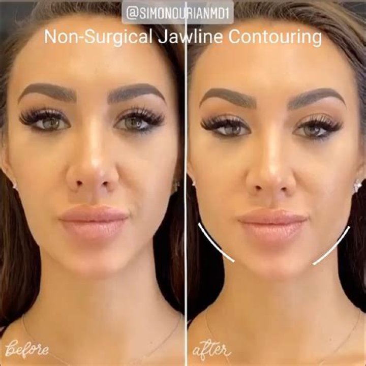 Simon Ourian's Jawline Contouring Procedure Is Reshaping Beauty Standards
